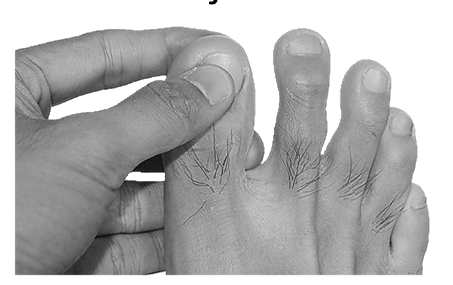 A. Het voetonderzoek Stap 2. Controleer de nagels Ingegroeide teennagel? Schimmelnagels? Wondjes onder de nagels?