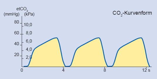 Voorbeeld f: Het normale capnogram valt gedeeltelijk weg en CO 2 is wel beademingssynchroon maar onvolledig aantoonbaar.