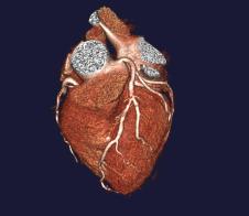 Diagnostic Accuracy 64-Slice CT Coronary Angiography In a patient-based analysis, the sensitivity for