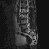 fl-ext lat b ax r motion (%) 14/10/2014 Posttherapeutische evaluatie Posttherapeutische evaluatie problemen na arthrodese Adjacent level disease Incidentie adjacent level degeneration: 34% adjacent