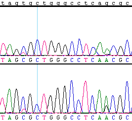 Tabel 38: Overzicht positieve stalen CSF3R-gen Patiënt Mutatie Staaltype Diagnose Moleculaire testen (Mutaties) FISH Verwijzing CC06 0611 AE06 0453 c.2260c>t (p.gln754x) c.2422g>a (p.