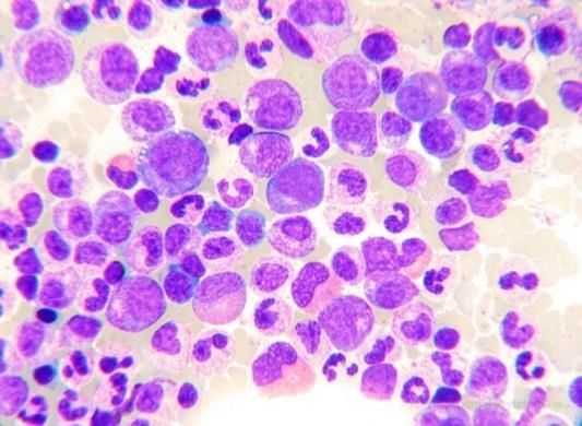 4.1.1.1.1 Chronische neutrofiele leukemie CNL is een uiterst zeldzame waarbij een blijvend hoog aantal neutrofiele granulocyten in de bloedsomloop bestaat (Swerdlow et al. 2008).