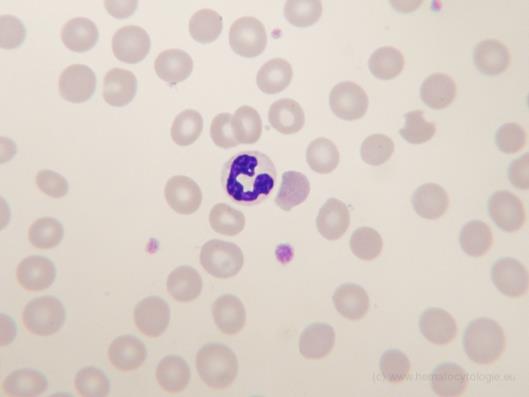 Figuur 4: Dysplasie perifeer bloed: granulocyt met slechte segmentatie, hypogranulatie en afwijkende chromatinecondensatie (Scholten 2013) Figuur 5: Dysplasie perifeer bloed: reuzentrombocyten