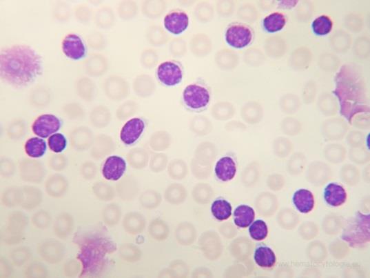 Figuur 21: Chronische lymfatische leukemie - Toename van rijpcellige lymfocyten met kenmerkende marmerstructuur in de kern en verspreid meerdere kapot gestreken cellen: gumprechtse schollen (Scholten