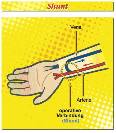 Protocollen Voorbehouden, Risicovolle en Overige handelingen Infuusbehandeling 26 Wanneer ook extra vocht en/of medicijnen toegediend moeten worden is het handig om twee (of meer) lumen te hebben.