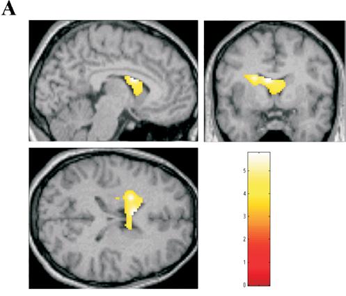 Gender differences in brain activity toward unpleasant linguistic stimuli concerning interpersonal relationships: an fmri study Eur