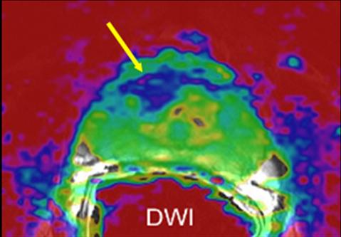 Voorbeelden diagnose met behulp van MRI 1. Kanker opgespoord met MRI Hieronder ziet u MRI s van een 67-jarige man met een verhoogd PSA-gehalte.