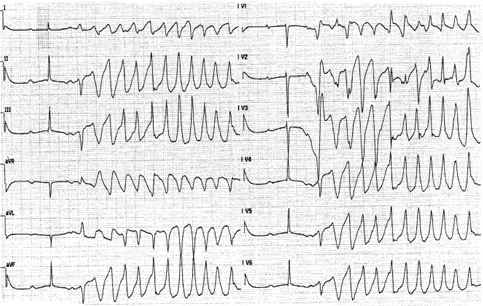 QTc-verlengende middelen Tamoxifen, lapatinib, pazopanib Risicofactoren: Onderliggende hartziekten Bradycardie Electrolytenstoornissen in combinatie met: Amiodarone (Cordarone