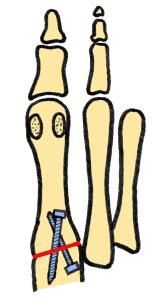 Ook wordt de teen rechtgezet via het tweede sneetje. Het gewrichtskapsel (stevig bindweefsel) dat om het gewricht heen zit, wordt ingekort.