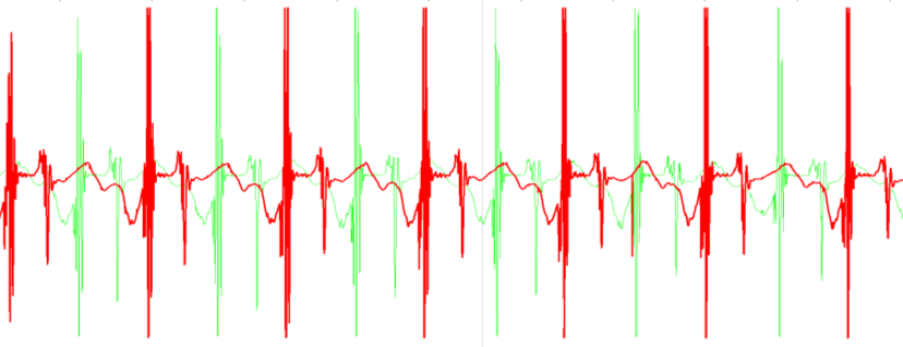 contacttijd sensoren (ms) Figuur 1: Voorbeeld van versnellingsensor signalen (voor- achterwaartse richting) tijdens hardlopen met sensoren op rechter (iets dikkere lijn) en linker voet.