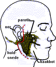 Behandeling Er bestaan 2 soorten operaties van de oorspeekselklier: 1. Oppervlakkige parotidectomie Meestal is het voldoende om een deel van de oorspeekselklier te verwijderen.