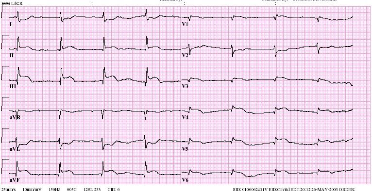 STEMI diagnose Bij inferior infarct: steeds rechter