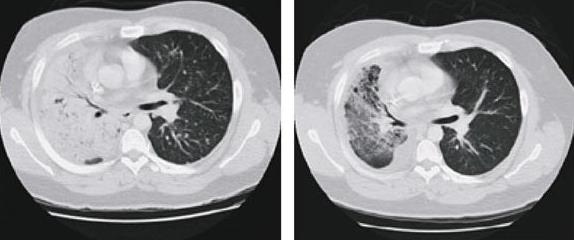 Male, diagnosed with lung cancer (adenocarcinoma) 10 months ago, 47 years, non-smoking Treated with chemotherapy, now developing recurrent disease Lazarus Response to Gefitinib: Chemoresistant EGFR