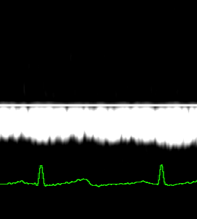 6.6.3 Cardiale functie Acceleration index (ACI) is de maximale versnelling van de bloedstroom in de aorta tijdens de systole. De gemiddelde normaalwaarde van ACI is 117 cm/sec².