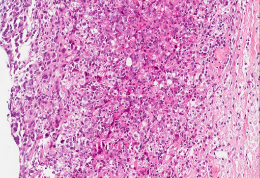 Casus - presentatie III 64 jarige vrouw CD20 CD30 WHO classificatie Anaplastic large cell lymphoma (ALCL)