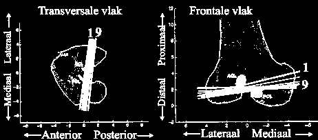 Figuur 19a en b. Simulatie van de slotstrekking met een model. a. Uitgangspositie van het femur in ca. 30 flexie. M is een marker welke op de ventro-mediale zijde van de mediale condyl is geplakt. b. Na rotatie tot volledige extensie om de scheve as blijkt de marker naar mediaal-dorsaal te zijn weggedraaid als gevolg van de endorotatiecomponent van de beweging.