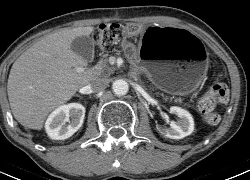 Patiënt : Man 67 jaar 2003 Diffuus type maagca antrum pt3n1 met beperkte maagretentie (2 x scopie) 2003 Partiële maagresectie; proximaal en distaal snijvlak tumorpositief (R1 x 2) Postoperatieve