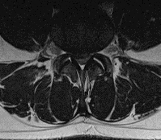 6 1 2 1 Tussenwervelschijf 2 Hernia MRI dwarsdoorsnede op het niveau van de