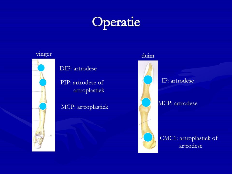 artroplastiek IP: artrodese MCP: