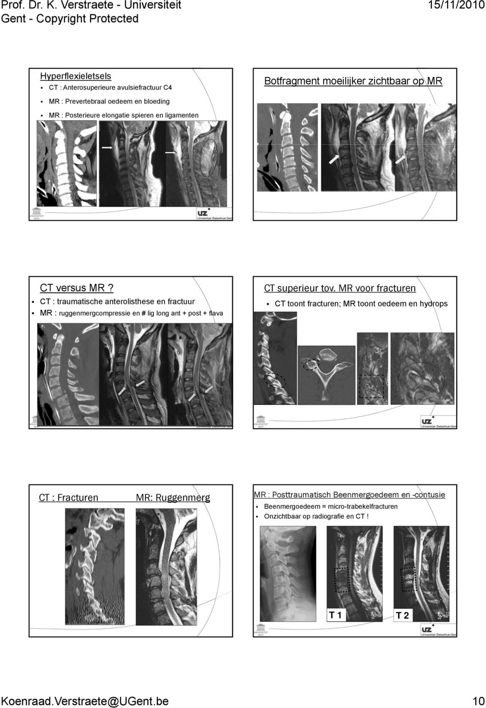 spieren en ligamenten Botfragment moeilijker zichtbaar op MR CT superieur tov. MR voor fracturen CT versus MR?