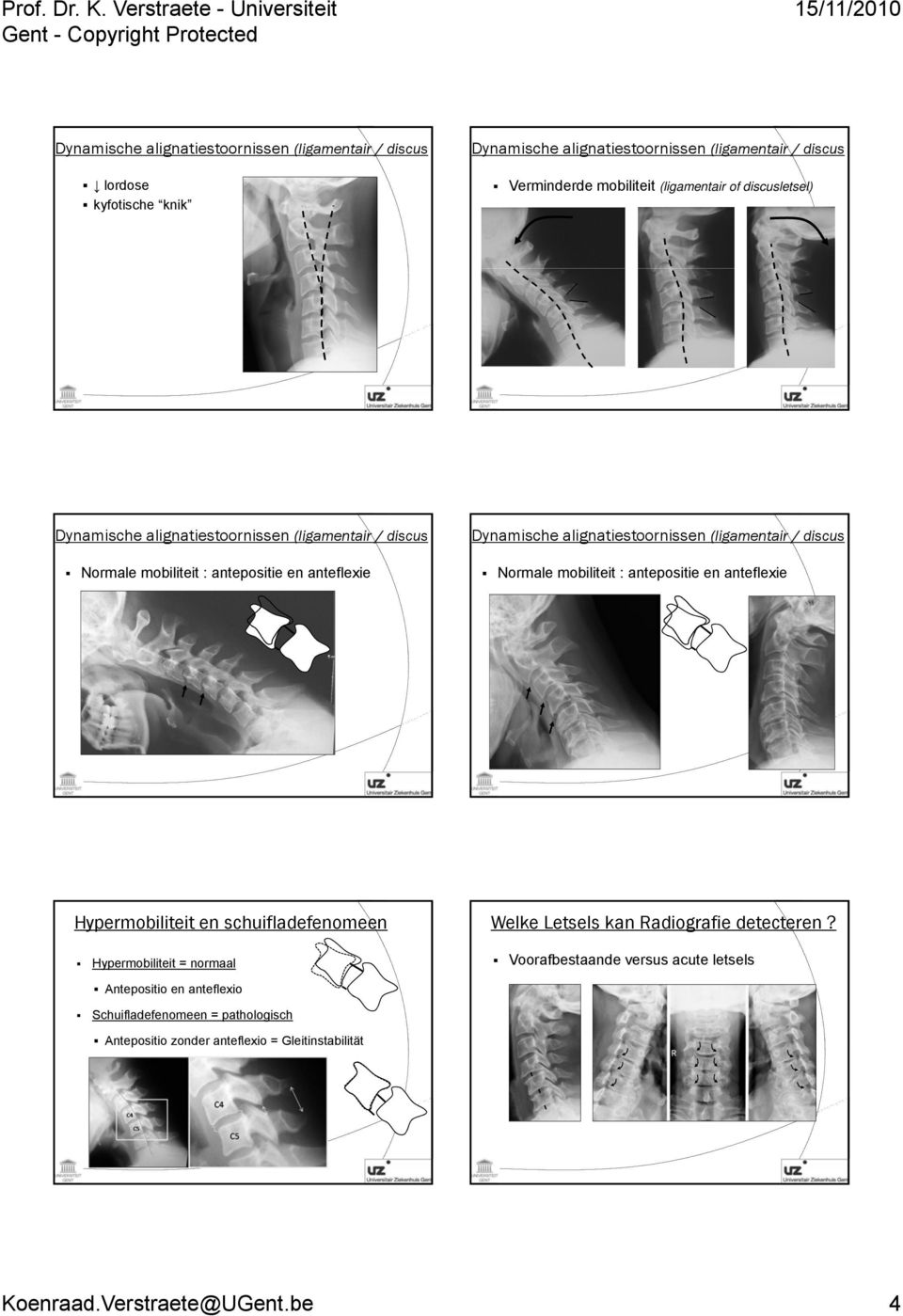 discus Normale mobiliteit : antepositie en anteflexie Hypermobiliteit en schuifladefenomeen Hypermobiliteit = normaal Welke Letsels kan Radiografie detecteren?