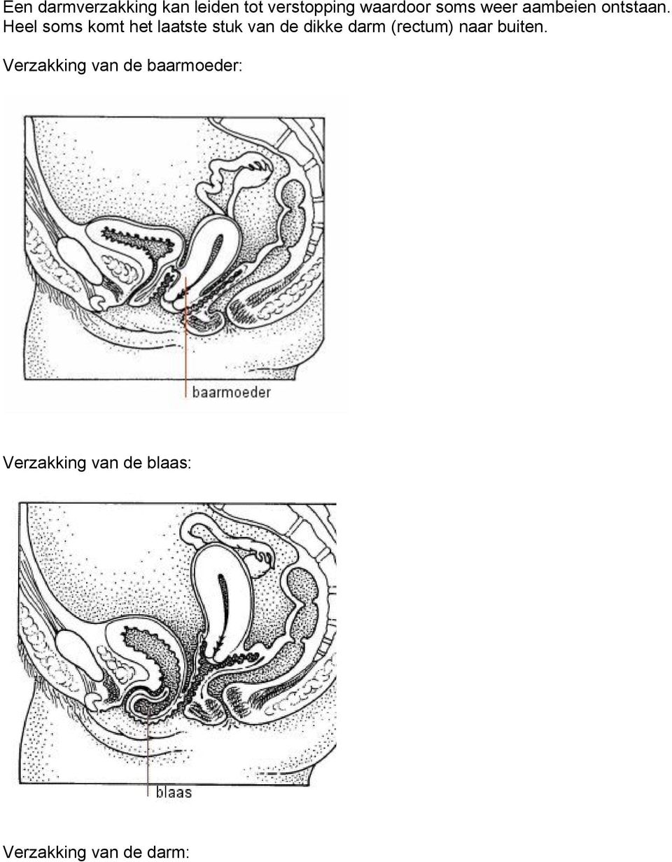 Heel soms komt het laatste stuk van de dikke darm (rectum)