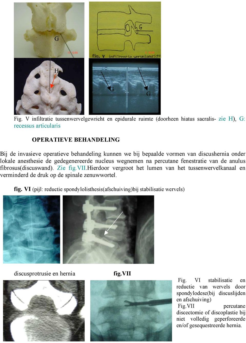 vormen van discushernia onder lokale anesthesie de gedegenereerde nucleus wegnemen na percutane fenestratie van de anulus fibrosus(discuswand). Zie fig.vii.