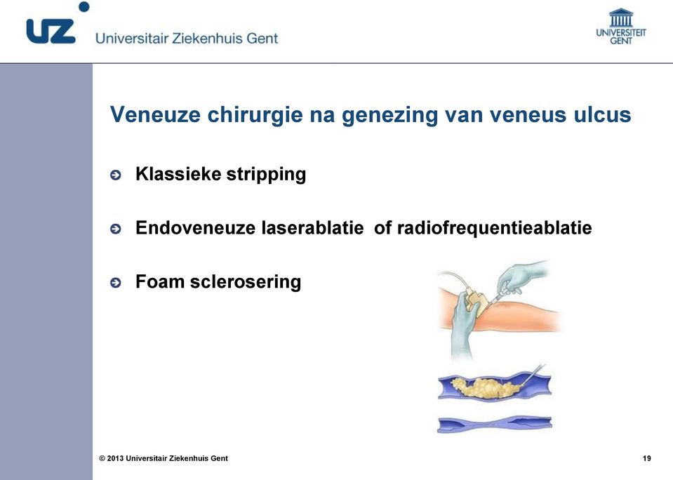 Endoveneuze laserablatie of