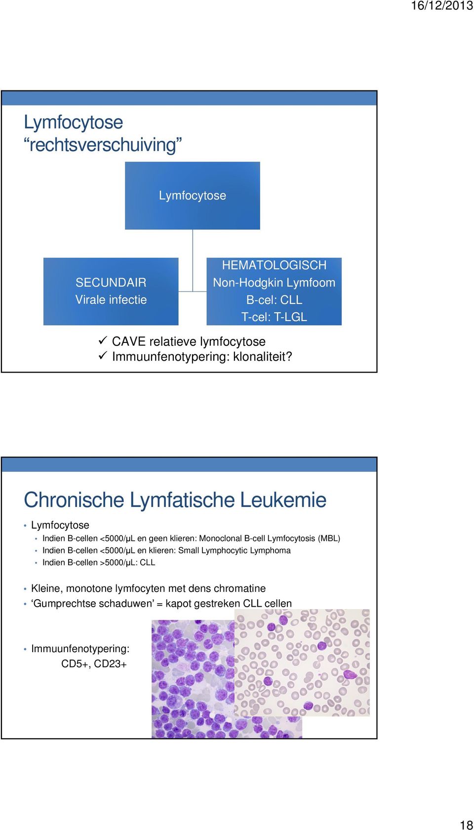 Chronische Lymfatische Leukemie Lymfocytose Indien B-cellen <5000/ L en geen klieren: Monoclonal B-cell Lymfocytosis (MBL) Indien