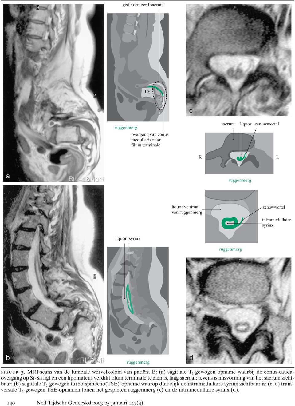 MRI-scans van de lumbale wervelkolom van patiënt B: (a) sagittale T 1 -gewogen opname waarbij de conus-caudaovergang op Si-Sii ligt en een lipomateus verdikt filum terminale