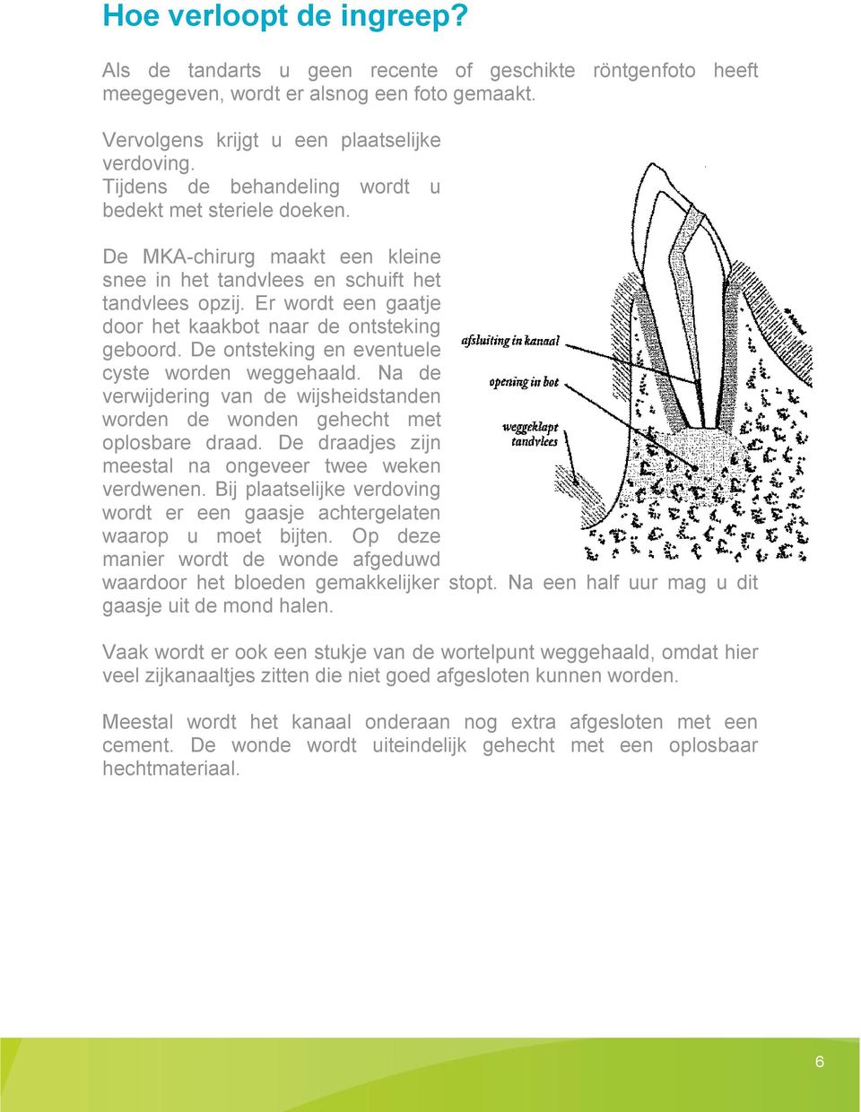 Er wordt een gaatje door het kaakbot naar de ontsteking geboord. De ontsteking en eventuele cyste worden weggehaald.