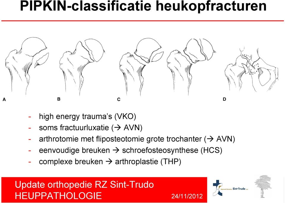 fliposteotomie grote trochanter ( AVN) - eenvoudige breuken