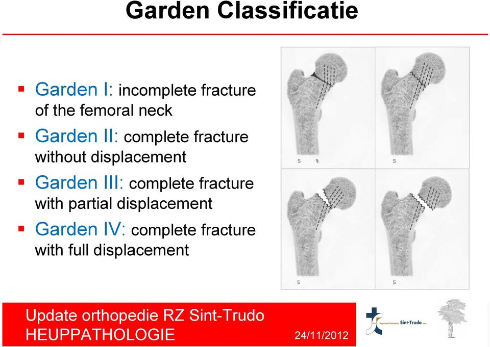 displacement Garden III: complete fracture with partial