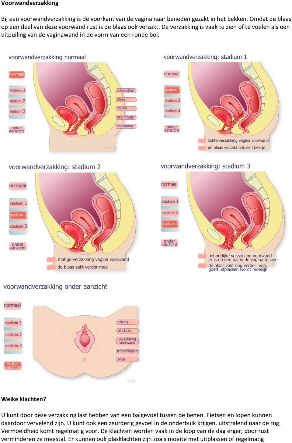 De verzakking is vaak te zien of te voelen als een uitpuiling van de vaginawand in de vorm van een ronde bol. Welke klachten?