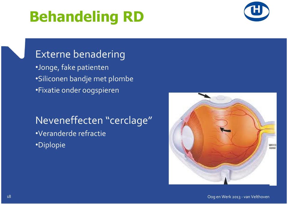 plombe Fixatie onder oogspieren