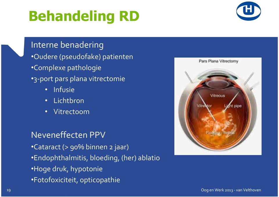 Vitrectoom Neveneffecten PPV Cataract(> 90% binnen 2 jaar)