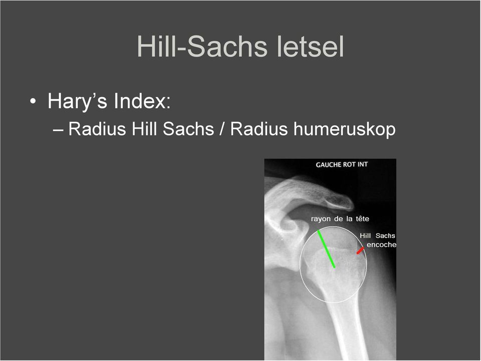 Radius Hill Sachs