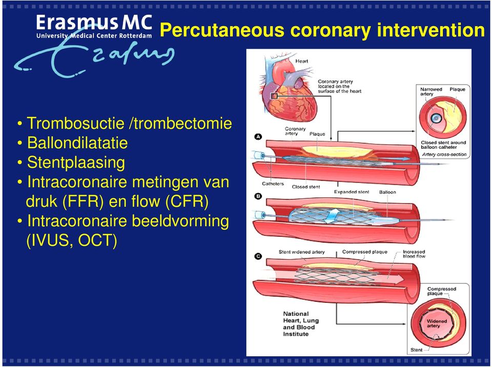 Stentplaasing Intracoronaire metingen van
