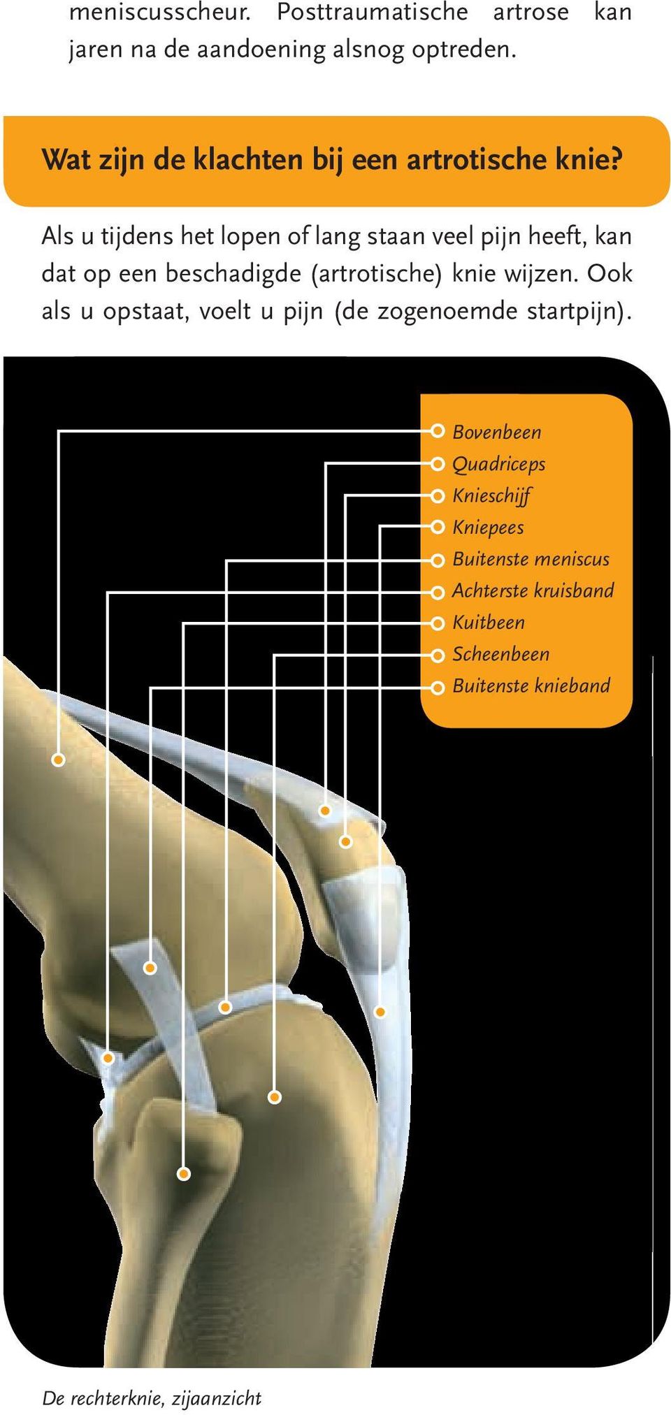Als u tijdens het lopen of lang staan veel pijn heeft, kan dat op een beschadigde (artrotische) knie wijzen.
