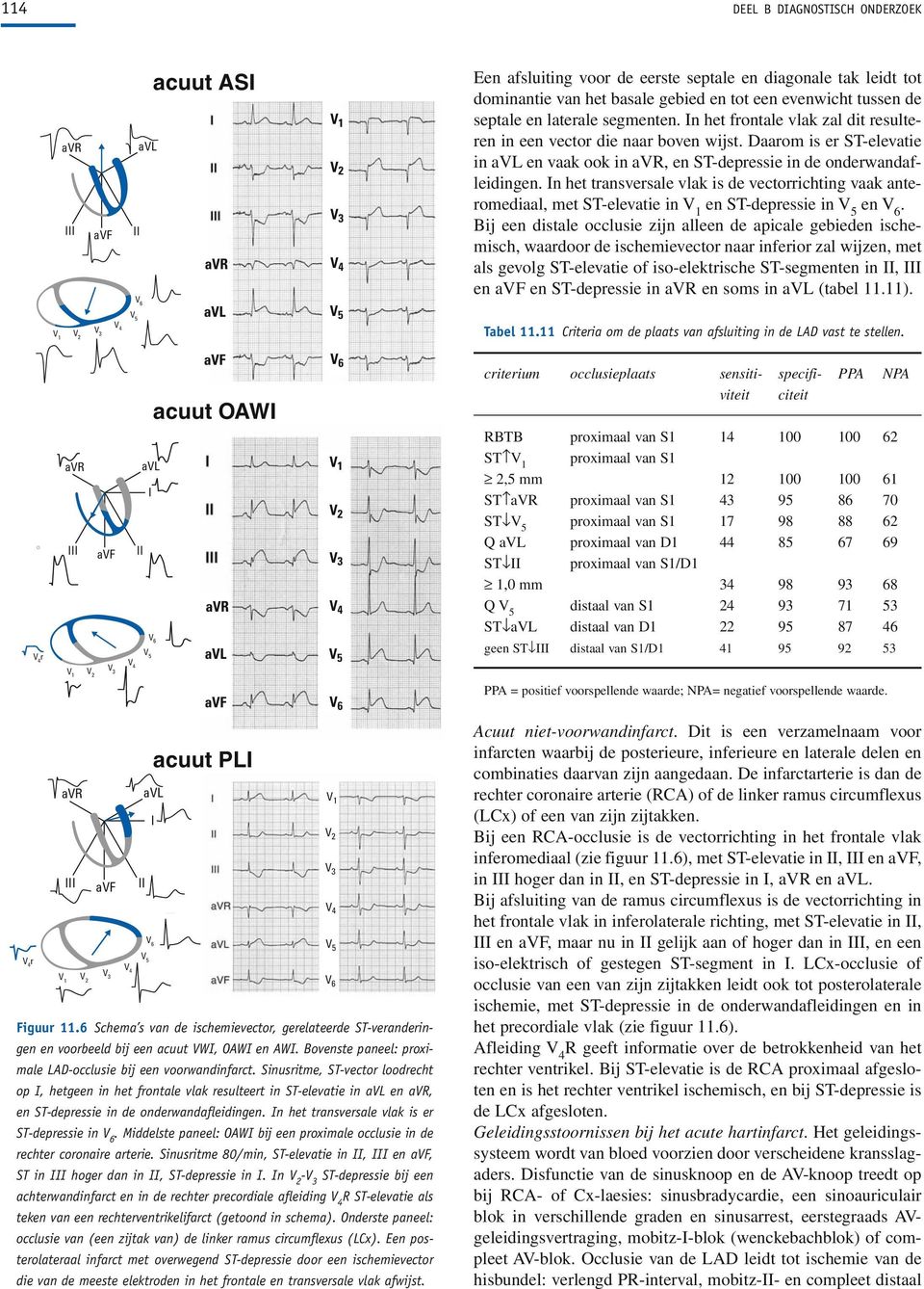 de vectorrichting vaak anteromediaal, met ST-elevatie in en ST-depressie in en Bij een distale occlusie zijn alleen de apicale gebieden ischemisch, waardoor de ischemievector naar inferior zal