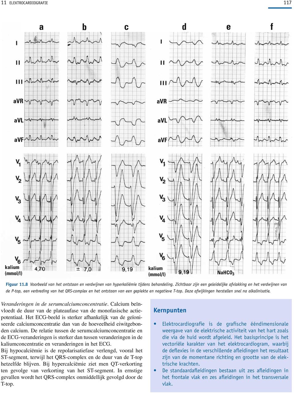 serumcalciumconcentratie Calcium beïnvloedt de duur van de plateaufase van de monofasische actiepotentiaal Het ECG-beeld is sterker afhankelijk van de geïoniseerde calciumconcentratie dan van de