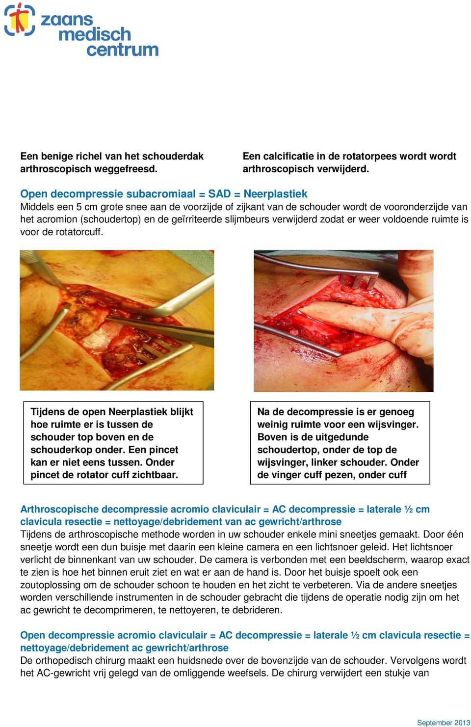 slijmbeurs verwijderd zodat er weer voldoende ruimte is voor de rotatorcuff. Tijdens de open Neerplastiek blijkt hoe ruimte er is tussen de schouder top boven en de schouderkop onder.