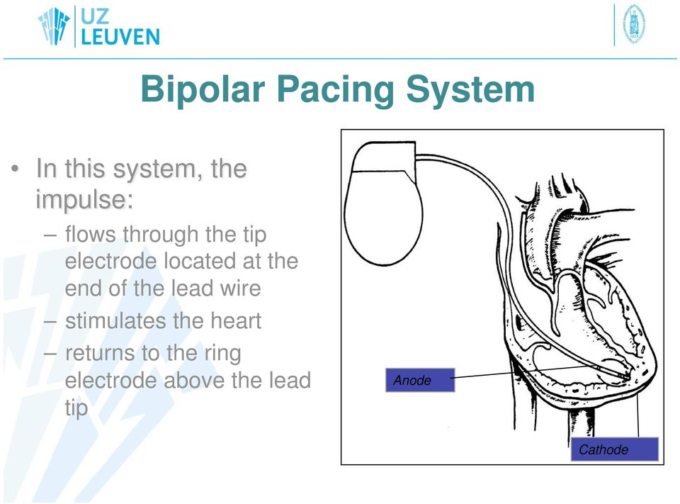 of the lead wire stimulates the heart returns to