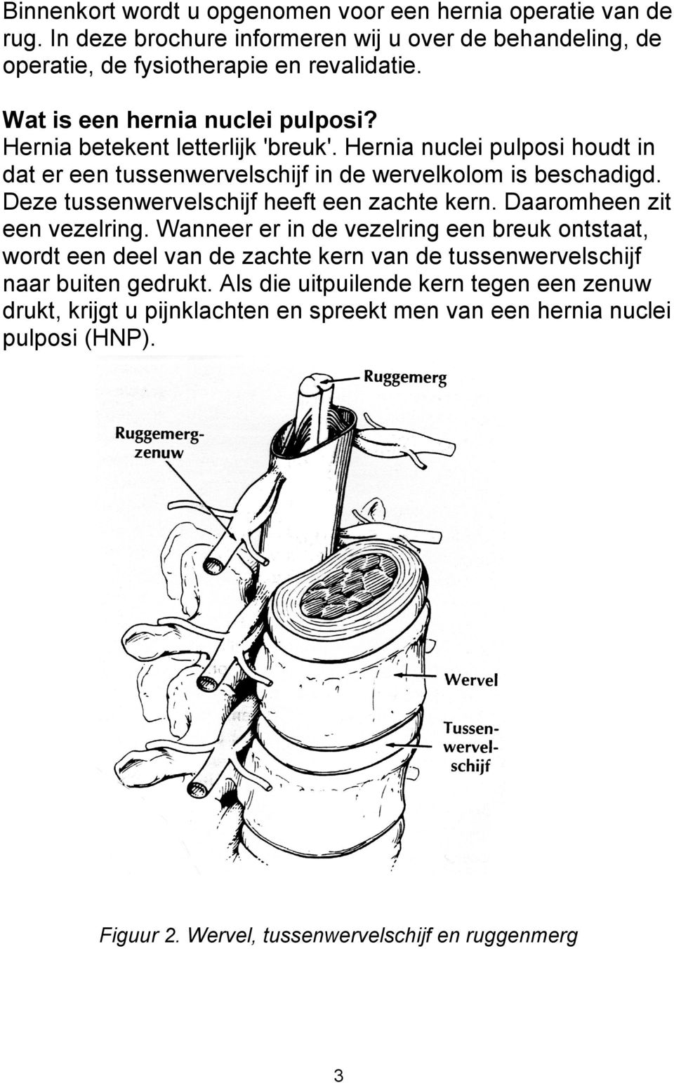 Deze tussenwervelschijf heeft een zachte kern. Daaromheen zit een vezelring.