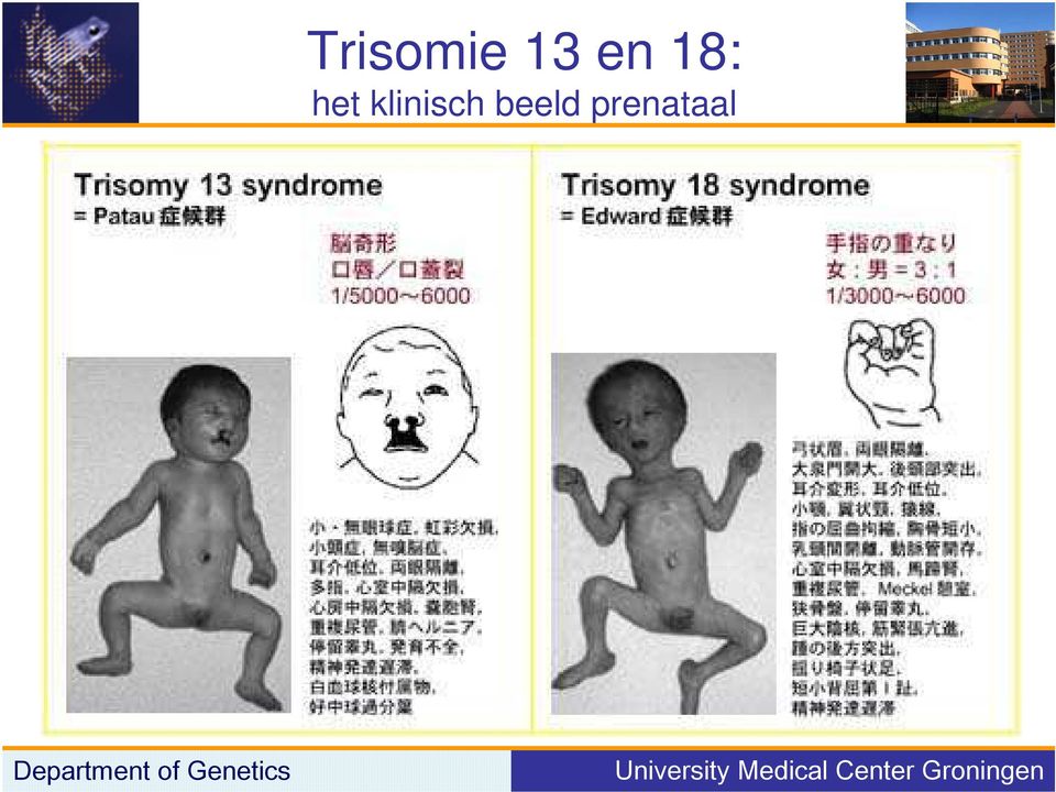 13/18 trisomie angst vor organscreening geschlecht
