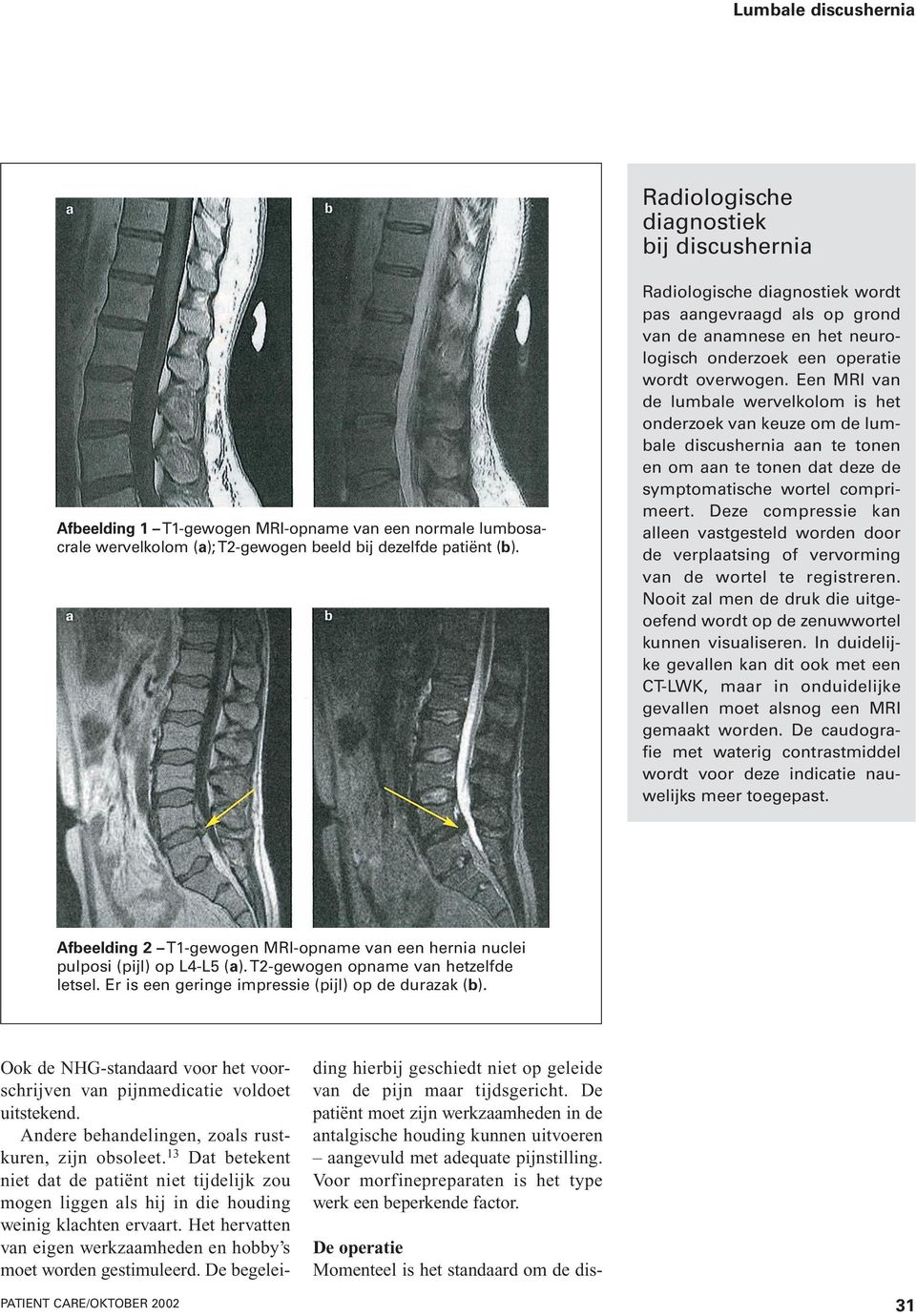 Een MRI van de lumbale wervelkolom is het onderzoek van keuze om de lumbale discushernia aan te tonen en om aan te tonen dat deze de symptomatische wortel comprimeert.