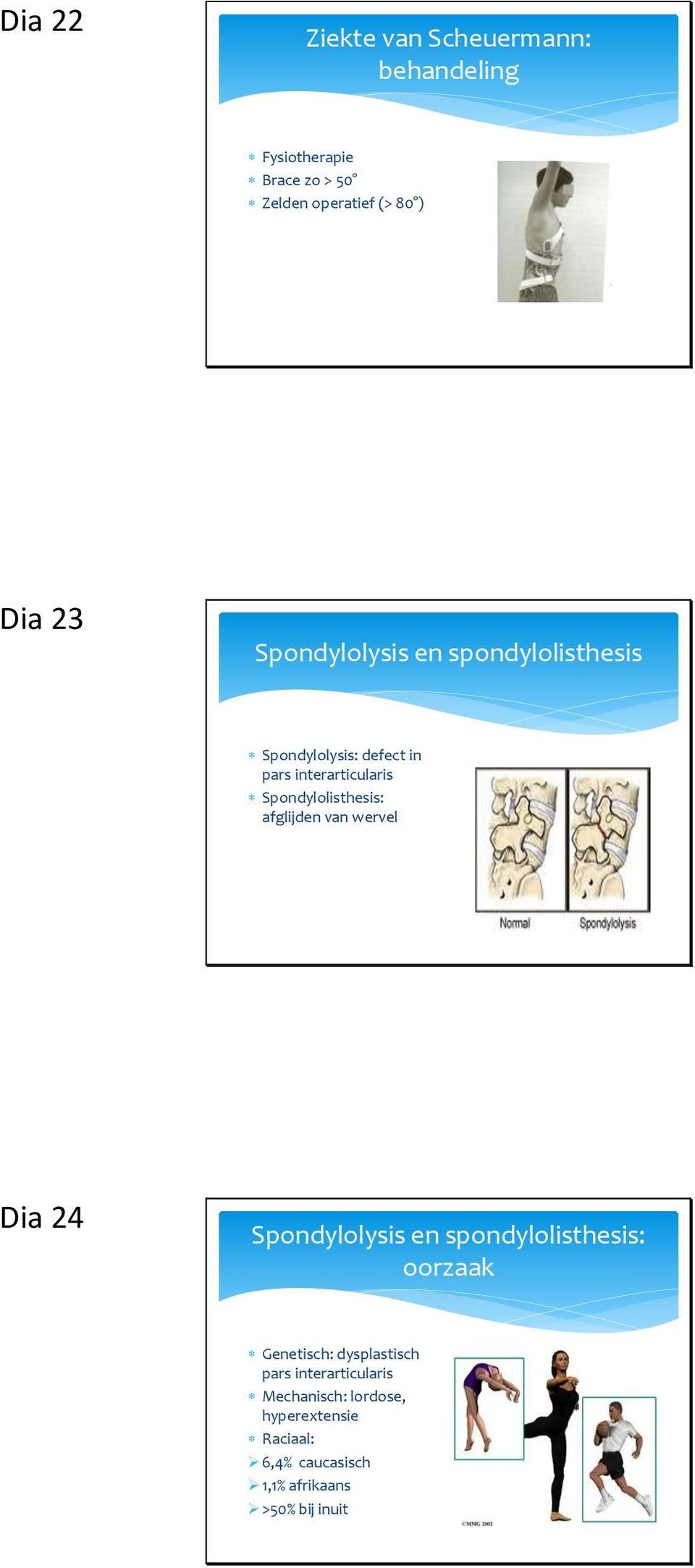 afglijden van wervel Dia 24 Spondylolysis en spondylolisthesis: oorzaak Genetisch: dysplastisch pars