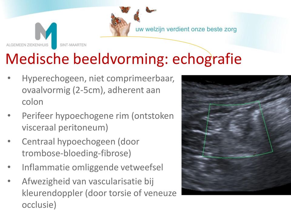 peritoneum) Centraal hypoechogeen (door trombose-bloeding-fibrose) Inflammatie