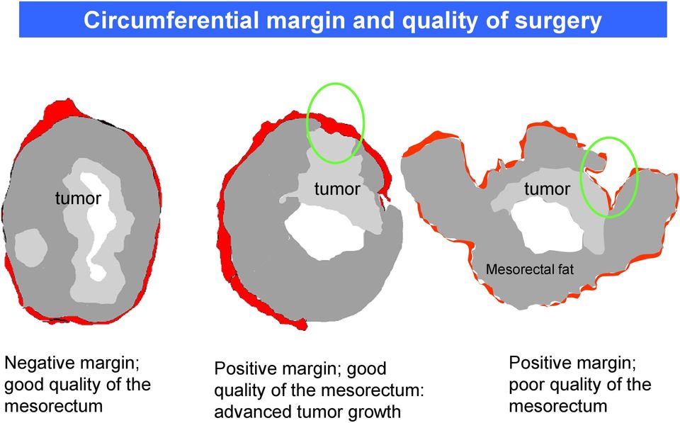 mesorectum Positive margin; good quality of the mesorectum: