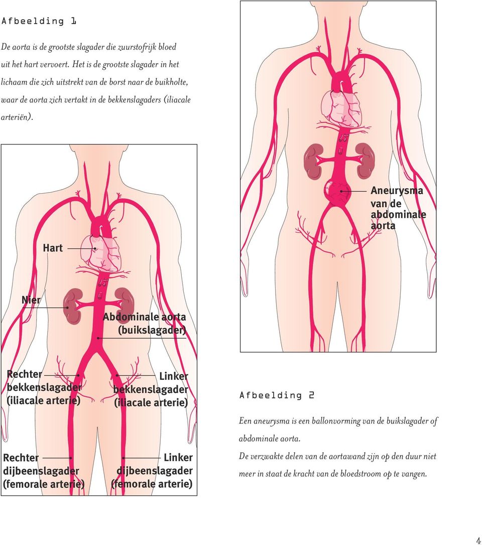 Aneurysma van de abdominale aorta Hart Nier Abdominale aorta (buikslagader) Rechter bekkenslagader (iliacale arterie) Rechter dijbeenslagader (femorale arterie) Linker bekken